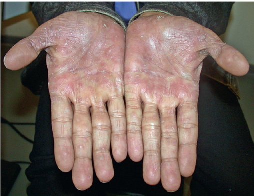EMNews's tweet photo. #Syphilis and its presentations are complex even for many #EPs, and cases are soaring. This #CME article by James R. Roberts, MD, about #serologictesting can help #EPs make the diagnosis. #FOAMed https://t.co/7Y0K5h9wiB https://t.co/lUM9hciVjt