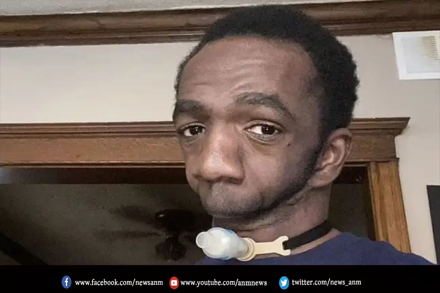 AnmNews's tweet image. इस शख्स के पास नहीं है जबड़ा

anmnewshindi.in/Home/GetNewsDe…

#physicalproblems #jawa #josephwilliams #raredisease