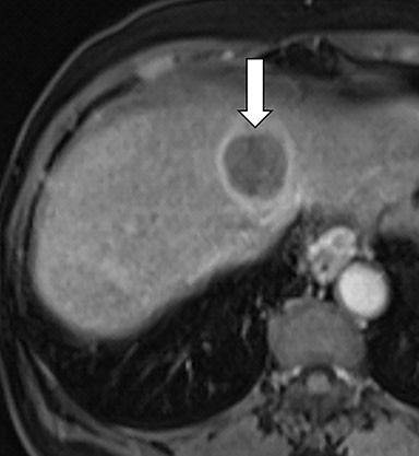 Applied_Rad's tweet photo. MRI Screening for Hepatocellular Carcinoma | This article reviews background information about cirrhosis and hepatocellular carcinoma, the role of screening, and diagnostic criteria for HCC. Earn 1 complimentary #SACME (Expires 6/30/22) ⏩https://t.co/Zc5hV9r6b3 #RadRes #FOAMrad https://t.co/c79XV6ppiz