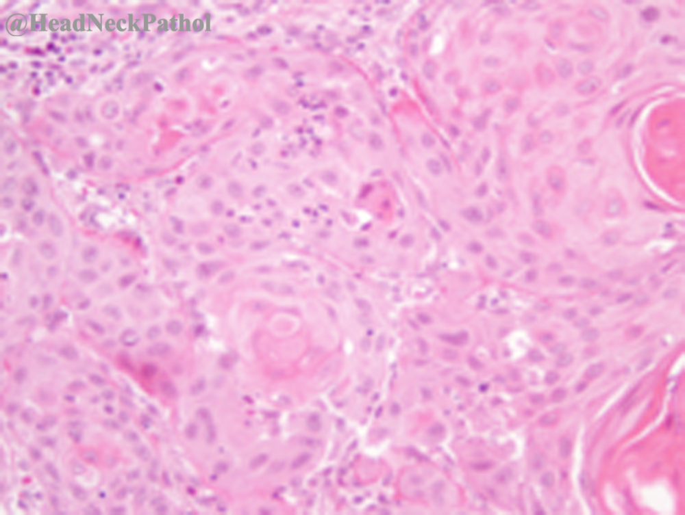 HeadandNeckPath's tweet photo. Comparison of Interleukin-1 Ligand Expression by Human Papilloma Virus Status in HNSCCs
By Ishrat Nourin Khan, Katherine N. Gibson-Corley, Joseph D. Coppock &amp; Andrean L. Simons 
https://t.co/GluMJFrC8Y
#HeadNeckPathol #HNPJ #HeadandNeckPath #Pathology #ENTPath #PathologyTweet https://t.co/RhZqbszKkF
