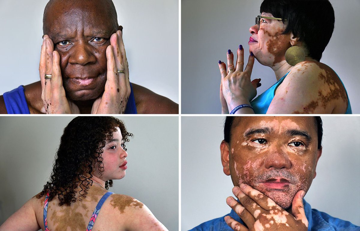 Reminder for Artists: Vitiligo is rarely symmetrical or isn’t just random pale spots. It looks different on everyone. And yes, even pale people can have it.