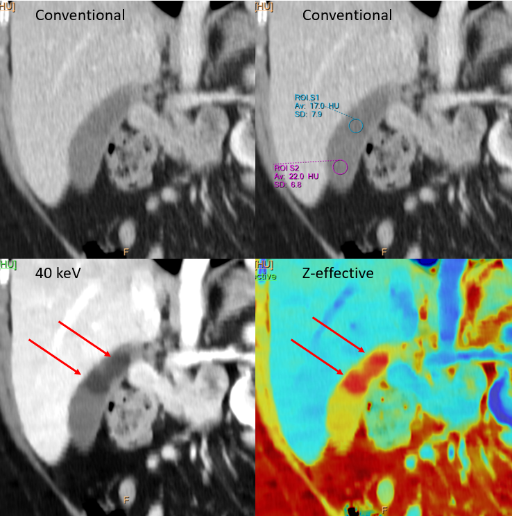 bwells80's tweet photo. Great tweet by CtSpectral. Check it out:
Noncalcified gallstones, simply invisible on conventional CT, show up really well on #SpectralCT.
US and MR for correlation.
#FOAMed https://t.co/a1m39MOp0V
— Gopal Punjabi (@CtSpectral)
May 22, 2022