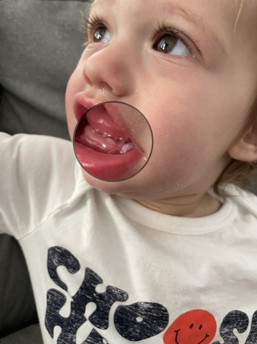 MerickLewin's tweet photo. We got our first tooth and apparently google photos has a magnifying circle feature! https://t.co/WpIlwaBscg
