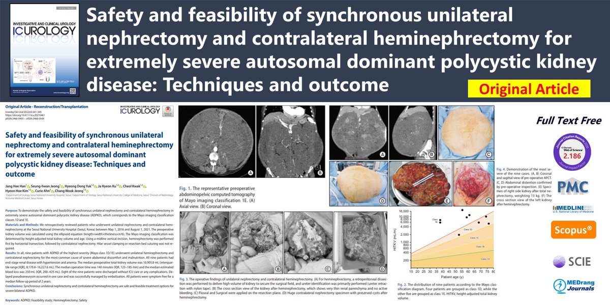 icurology's tweet photo. Safety and feasibility of synchronous unilateral nephrectomy and contralateral heminephrectomy for extremely severe autosomal dominant polycystic kidney disease:Techniques and outcome
🌷https://t.co/x6WAnLVQxk
2022 May;63(3)Jang Hee Han
#ADPKD #Feasibility_study #Heminephrectomy https://t.co/1lQNK7B9gX