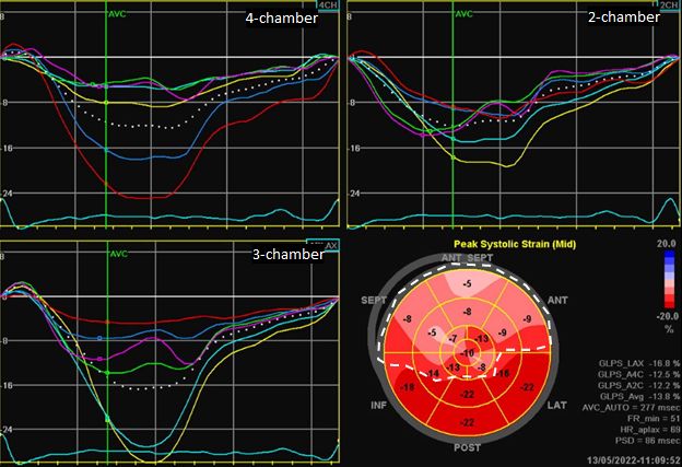echobyweb's tweet image. Apical hypertrophic cardiomyopathy &amp;amp; LA systolic stunning in the EP dept. Follow link to case: echobyweb.com/homepage/atlas…
#cardiotwitter #cvimaging #cvEcho #echofirst #cardiology #HCMapical