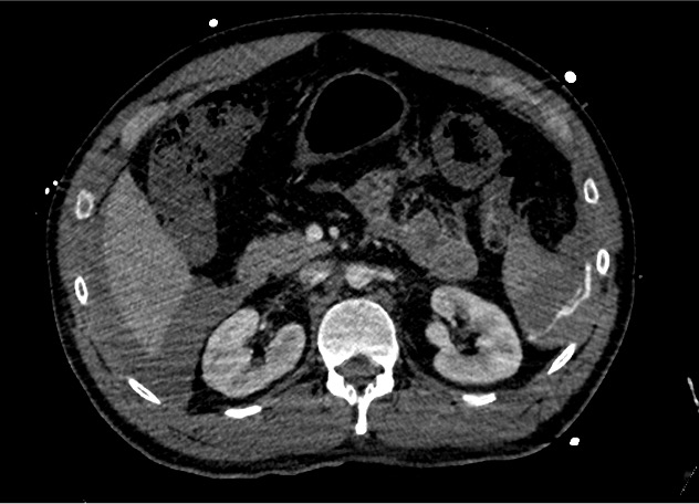 Junior Radiologie Interventionnelle (@juri_fr) on Twitter photo Cas Clinique : Traumatisme splénique sur AVP
Patient instable à l'arrivé, stabilisé sous amines. Angioscanner 👇 Quelle attitude ?
La réponse ce soir à 19h sur Zoom avec <a href="/FrandonJulien/">frandon julien</a> et <a href="/maximeronot/">Maxime Ronot</a>
x.com/JURI_Fr/status…
<a href="/RadiologieUNIR/">UNIR Radiologie</a>
<a href="/ETF_IRtrainees/">CIRSE European Trainee Forum</a>
<a href="/GuERI_France/">GuERI</a> Cas Clinique : Traumatisme splénique sur AVP
Patient instable à l'arrivé, stabilisé sous amines. Angioscanner 👇 Quelle attitude ?
La réponse ce soir à 19h sur Zoom avec <a href="/FrandonJulien/">frandon julien</a> et <a href="/maximeronot/">Maxime Ronot</a>
x.com/JURI_Fr/status…
<a href="/RadiologieUNIR/">UNIR Radiologie</a>
<a href="/ETF_IRtrainees/">CIRSE European Trainee Forum</a>
<a href="/GuERI_France/">GuERI</a>