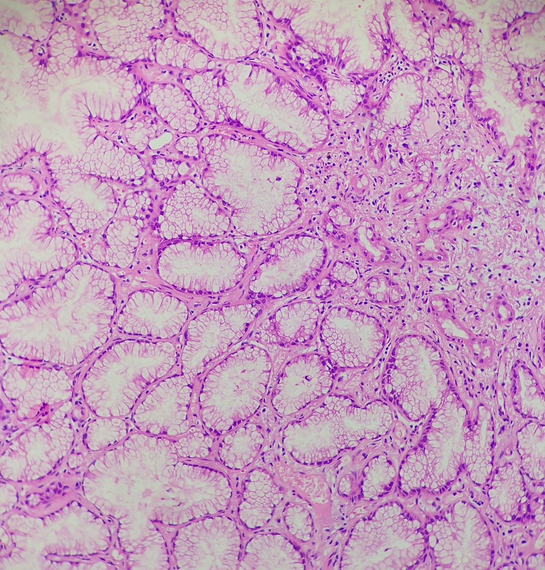 Andy_pathology's tweet photo. Lung tumor https://t.co/tEcTS38YTI