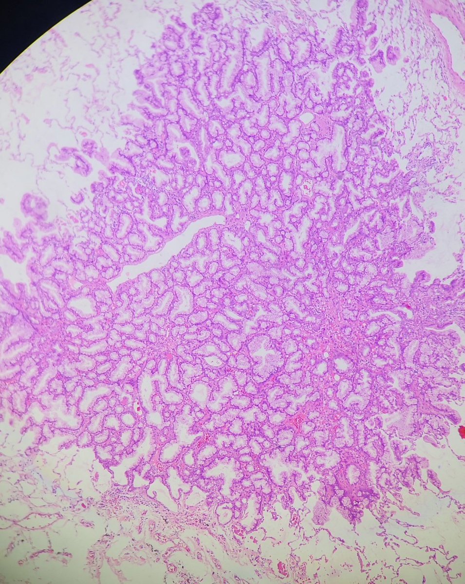 Andy_pathology's tweet photo. Lung tumor https://t.co/tEcTS38YTI