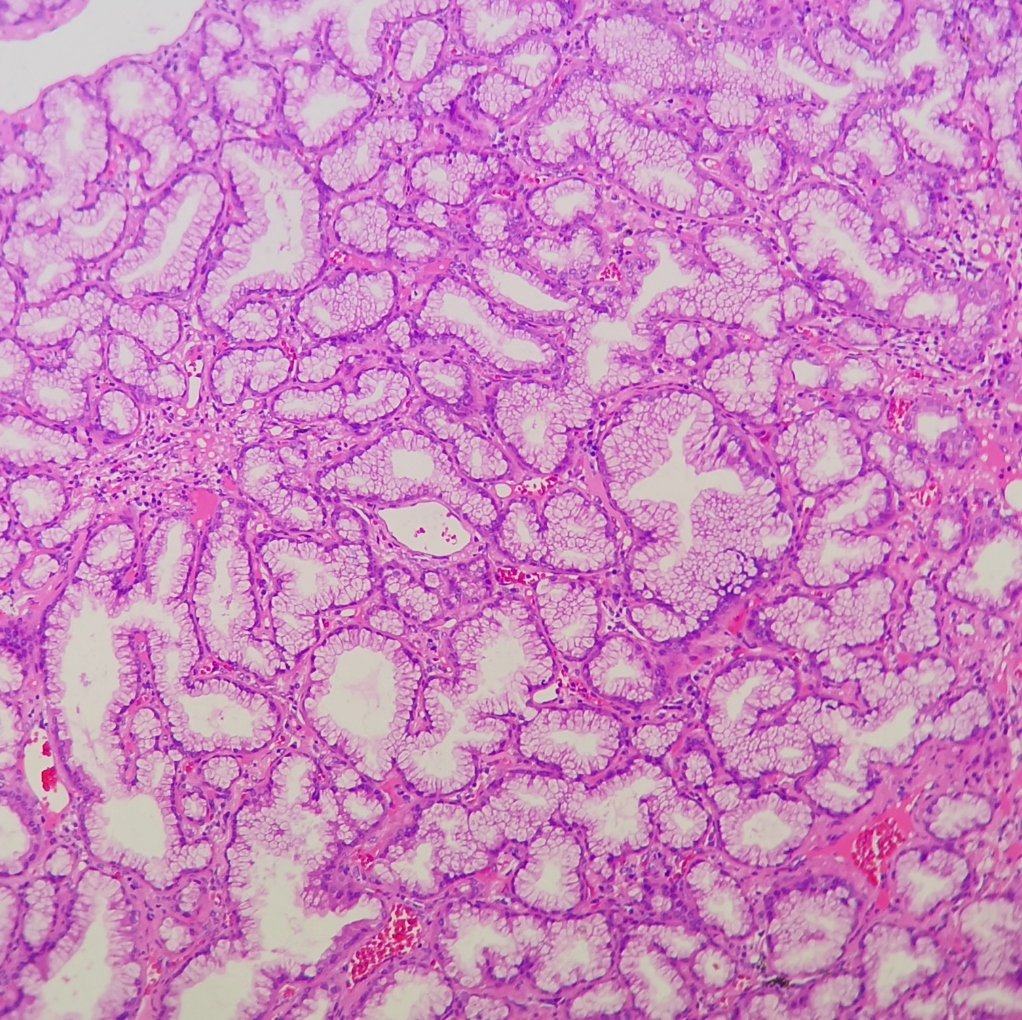Andy_pathology's tweet photo. Lung tumor https://t.co/tEcTS38YTI