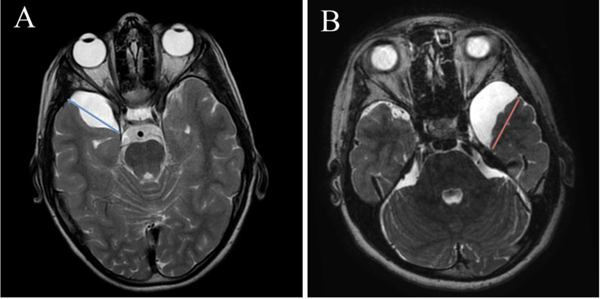 #OnlineFirst: Temporosylvian arachnoid cysts in children. Part 1: Cognitive profile of children with a temporal cyst and impact of the cyst in daily life. A prospective study in 100 consecutive children.
thejns.org/pediatrics/vie…