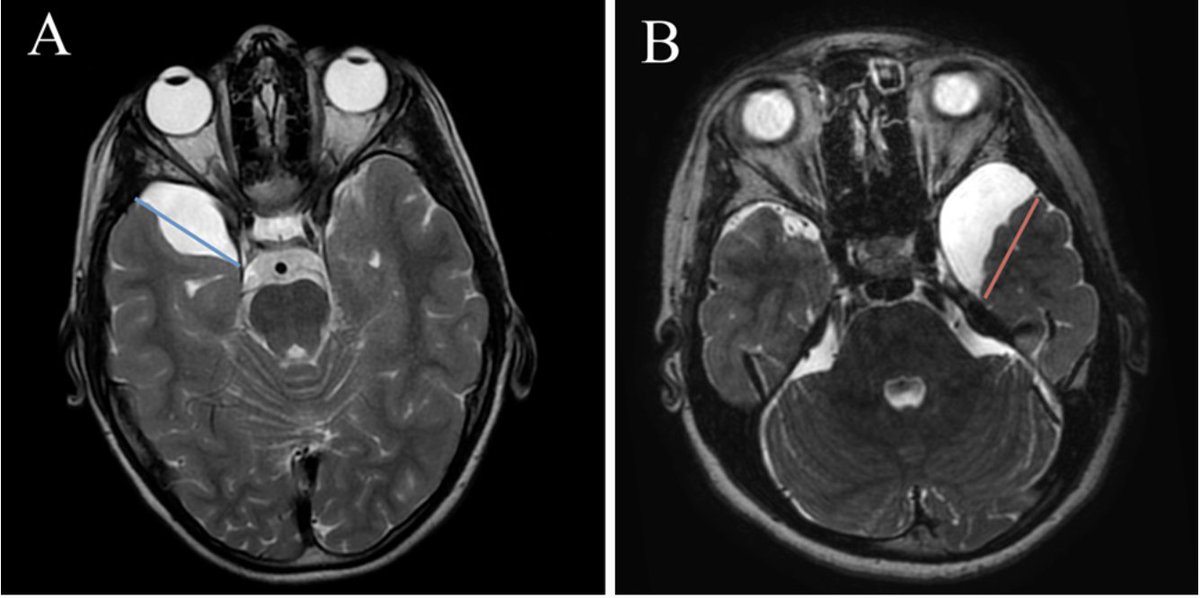 #OnlineFirst: Temporosylvian arachnoid cysts in children. Part 1: Cognitive profile of children with a temporal cyst and impact of the cyst in daily life. A prospective study in 100 consecutive children. thejns.org/pediatrics/vie…