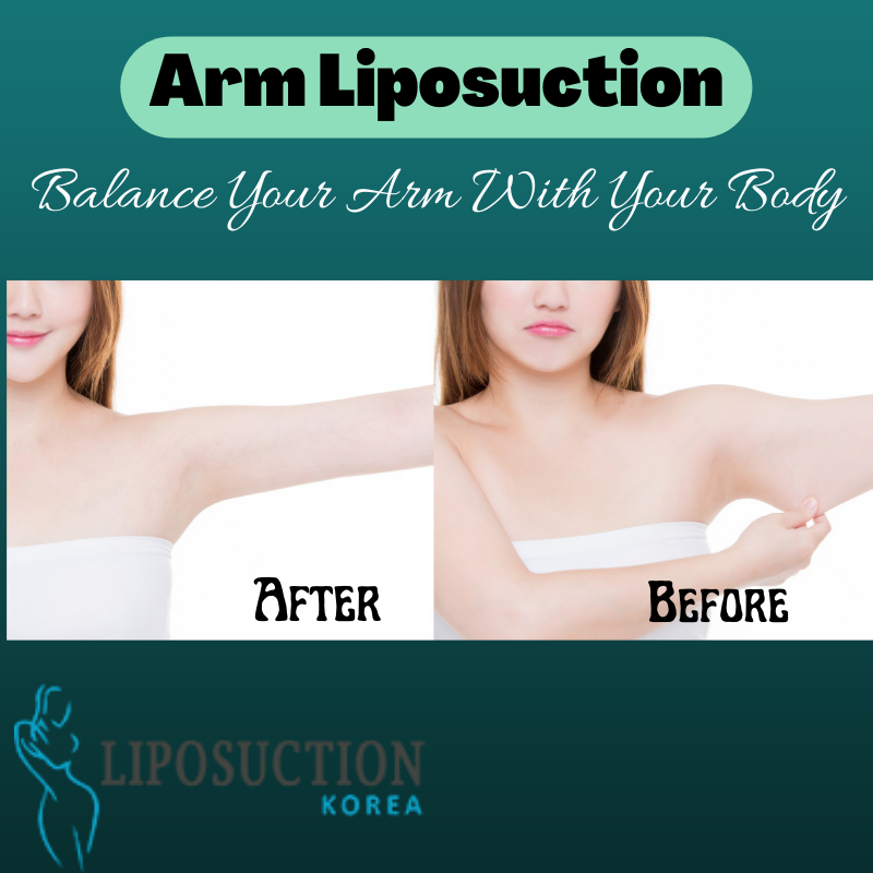 liposuctionkr's tweet photo. 𝐀𝐫𝐦 𝐋𝐢𝐩𝐨𝐬𝐮𝐜𝐭𝐢𝐨𝐧 is a cosmetic surgical procedure to remove excess fat from under the skin of the upper arm to obtain shapely arms.
Consult👇
Email at📩: info@liposuctionkorea.com
https://t.co/T0mfTvR1IW
➡ Inbox Us: https://t.co/RaR0IM0BPf https://t.co/HC7bqi0wSY