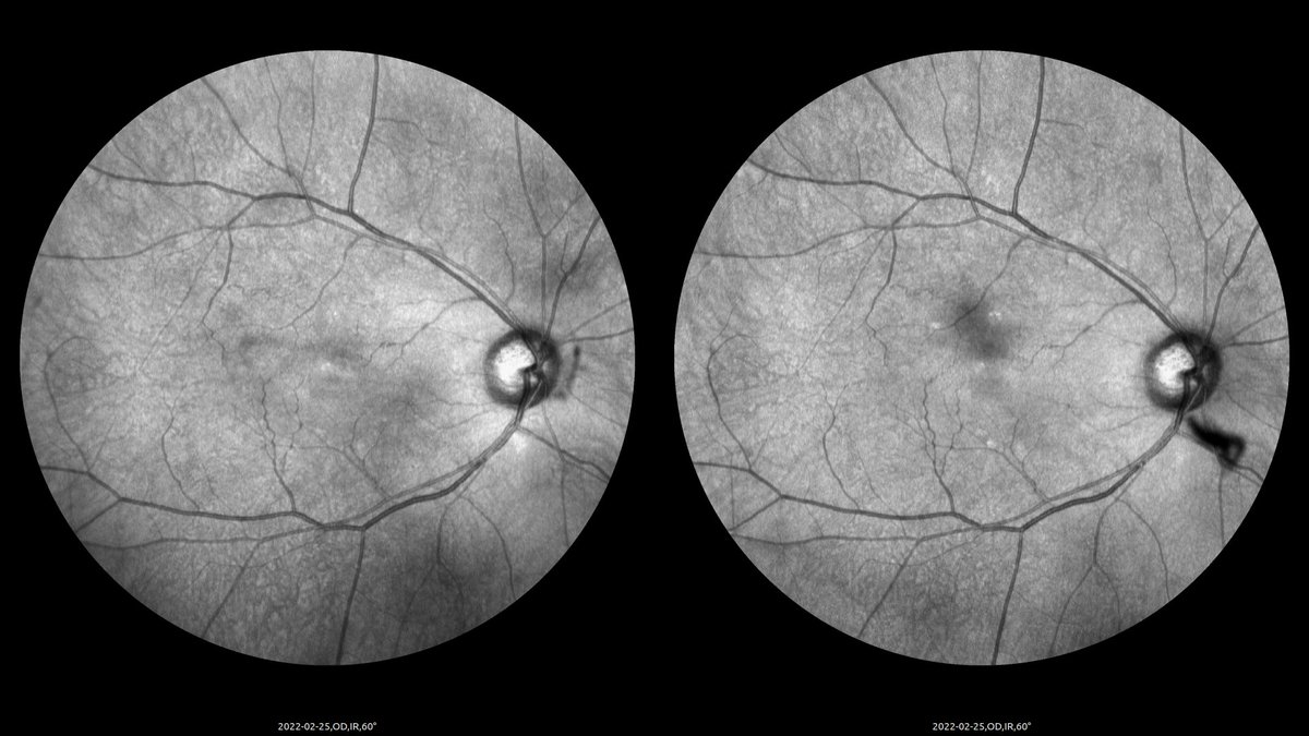 #Floaters
Before and after #lasersugery
Picured by Apollo, the #ConfocalRetinalOphthalmoscope
#retinopathy #funduscamera #vitreousopacity
