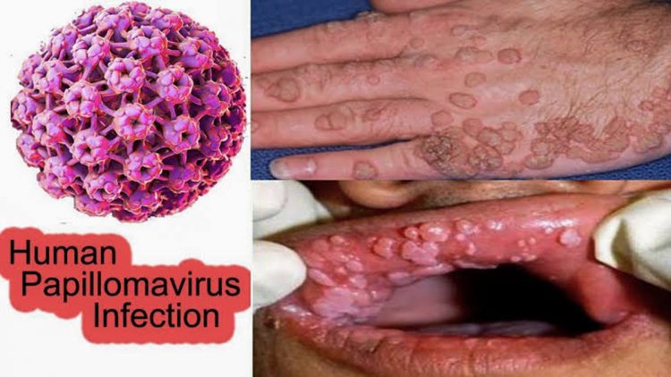 hpv oltó férfiak amikor a nemi szemölcsökből gyógyulnak a sebek