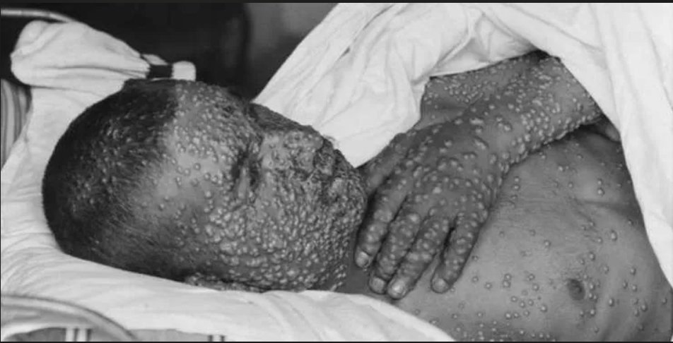 DocAnarchy's tweet photo. We must never lockdown again. 

The way governments worldwide handled the covid-19 pandemic was overbearing, expensive, and dangerous. 

It seems Monkeypox or Smallpox are the next pandemic they're pushing. 

How should it be handled? 
Let's find out 👇 https://t.co/EOdHQNVdX8