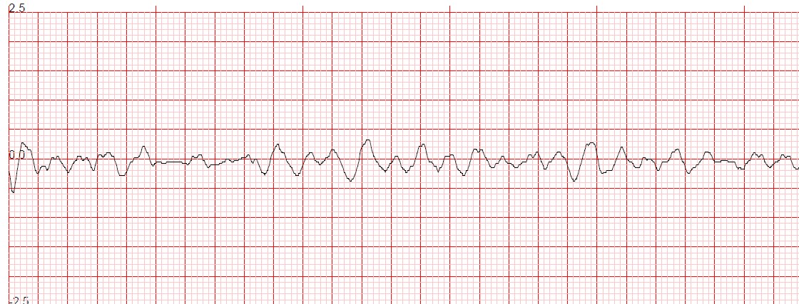 BENEA5T's tweet image. #FirstOnScene to a #CardiacArrest 26 seconds after arrival the first shock was given! #CPR and #ROSC #ReturnOfSpontaneousCirculation Two shocks given before @OFFICIALWMAS arrived #CFR Want to be a Community First Responder and make a difference in our #Community ? Recruiting NOW!