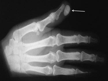 #FOAMed Case: annemergmed.com/article/S0196-…
• 76 y/o male with a 1-year history of a mass on his right thumb
• PT had experienced skin-penetrating trauma by Christ thorn 2 years earlier
• On PE a painless soft tissue mass of the end of the right index finger was observed