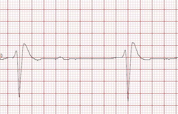 BENEA5T's tweet image. #FirstOnScene to a #CardiacArrest 26 seconds after arrival the first shock was given! #CPR and #ROSC #ReturnOfSpontaneousCirculation Two shocks given before @OFFICIALWMAS arrived #CFR Want to be a Community First Responder and make a difference in our #Community ? Recruiting NOW!