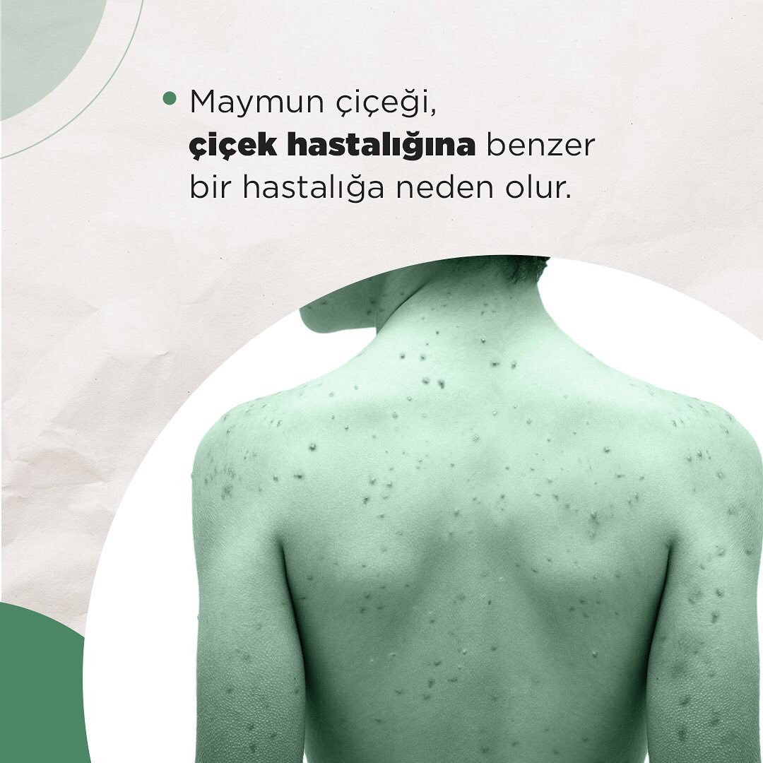 lotusnewstr's tweet image. Maymun Çiçeği virüsü alarmı tüm dünyayı sarstı. Virüsün neden olduğu görüntüler korku ve paniği bir kat daha artırdı. Virüsle ilgili kamuoyunda en çok merak edilip araştırılanlar arasında "Maymun Çiçeği virüsü nedir, belirtileri nelerdir?" konuları yer aldı.
#LotusNews