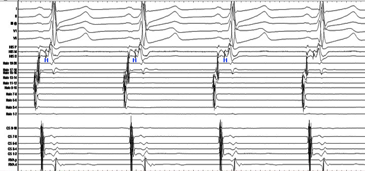 annavarr's tweet photo. #Epeeps @EPeeps_Bot    Orthodromic SVT mediated by RAL pathway .In addition the patient had a FV pathway. https://t.co/5ZOtB9qdX3