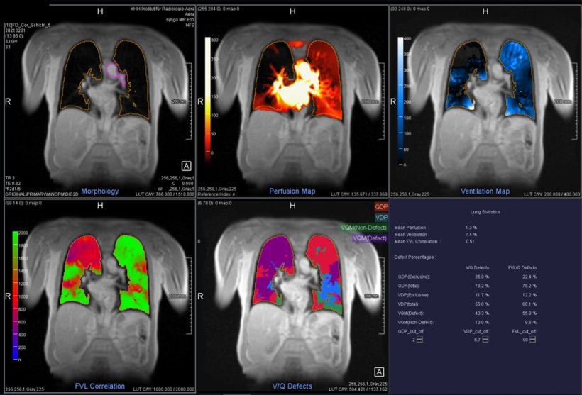 EuropHospital's tweet photo. Advances in image post-processing and contrast-enhanced techniques have widened the scope of possibilities for #MRI and #ultrasound vascular imaging, experts showed in a dedicated course at the #ECROverture. @myESR https://t.co/gvi6QHrgCZ https://t.co/bBEahcsOor
