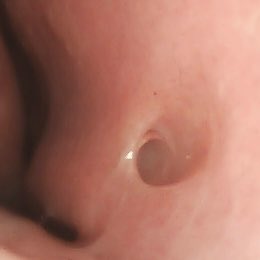 WilliamRBlythe's tweet photo. Jacobson’s Organ of the nasal septum.
#ENTwitter #GeneralENT https://t.co/fxTVjSqddD
