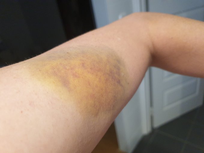 Bruise update!  Looking very colourful! https://t.co/3cmBMWygOx