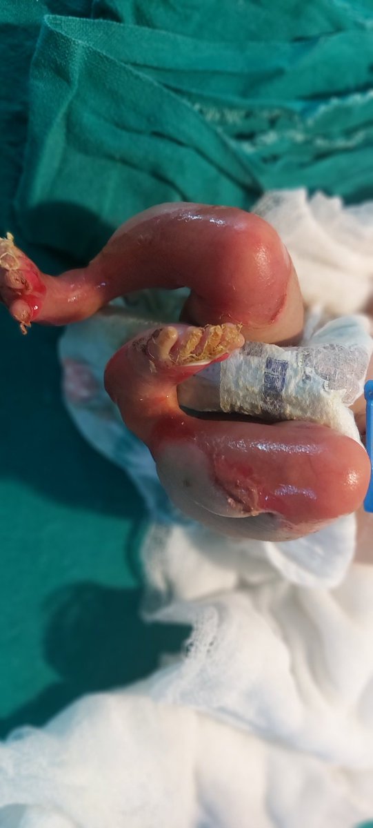 shi_kan_va_del's tweet photo. #Rare_case
S/L/T/F/NVD(healthpost)/AGA(2.5) with uneventful perinatal history presented with mucocutanous/bullous disease with positive koebner phenomenon and Normal blood counts, negative CRP.
No medical, radiological exposure history of mother. https://t.co/jewK0aiy0W