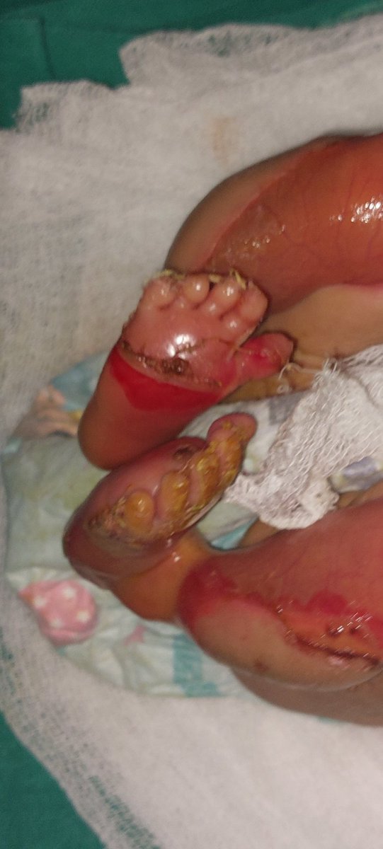 shi_kan_va_del's tweet photo. #Rare_case
S/L/T/F/NVD(healthpost)/AGA(2.5) with uneventful perinatal history presented with mucocutanous/bullous disease with positive koebner phenomenon and Normal blood counts, negative CRP.
No medical, radiological exposure history of mother. https://t.co/jewK0aiy0W