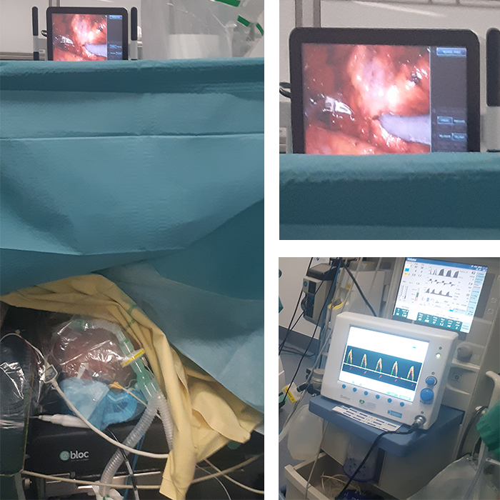 📍 Hôpital Saint Louis, <a href="/APHP/">Assistance Publique – Hôpitaux de Paris (AP-HP)</a> 
Monitorage hémodynamique de néphrectomie mini-invasive Da Vinci avec l'ODM+ 
<a href="/Deltex_Medical/">Deltex Medical Ltd</a>
  #doppler