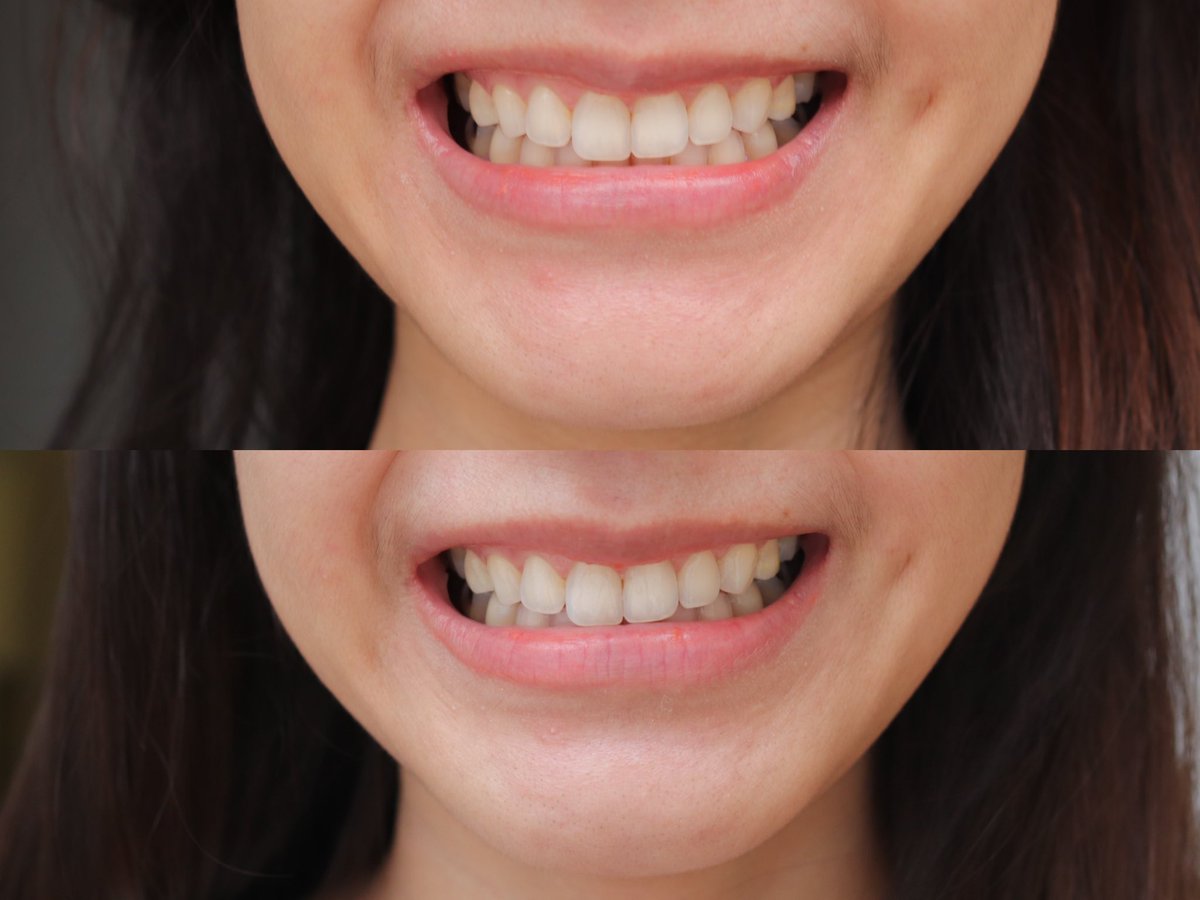 peartunwarat's tweet image. ป้ายยา! ยาสีฟันสูตรฟันขาวตัวใหม่ ไอเทมเด็ด เหมาะกับ lifestyle แบบเรา Optic White O2 ตัวใหม่ของคอลเกต ชอบความรู้สึกตอนเริ่มแปรงมาก จะรู้สึกอุ่นๆ ฟองโฟมนุ่ม สบายปากมาก ใช้นาน 3-4 วันละ ฟันขาวขึ้น 1 เฉดจริง ลองมาแล้วกับตัวเอง อะเมซิ่งมาก รู้สึกมั่นใจขึ้นเลย #SmileOutLoud