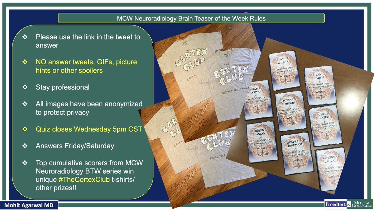 @X (@publishedxprime) on Twitter photo #MCWNeuroradBTW 072:Epistaxis
PLS DO NOT POST ANS/HINTS IN COMMENTS.Submit answers@ mcwisc.co1.qualtrics.com/jfe/form/SV_0q…
Quiz closes Wed5PM,Ans Fri
#radres #FOAMed #MedEd #MedTwitter <a href="/TheASNR/">The American Society of Neuroradiology</a> <a href="/ARRS_Radiology/">ARRS</a> <a href="/BSHNI_UK/">British Society of Head & Neck Imaging</a> <a href="/BshniTrainees/">BSHNI Trainees</a> <a href="/ASHNRSociety/">ASHNR</a> <a href="/RadDiscord/">RadDiscord</a> <a href="/ESHNRSociety/">ESHNR</a> <a href="/ESNRad/">ESNR</a> @AURtweet #MCWNeuroradBTW 072:Epistaxis
PLS DO NOT POST ANS/HINTS IN COMMENTS.Submit answers@ mcwisc.co1.qualtrics.com/jfe/form/SV_0q…
Quiz closes Wed5PM,Ans Fri
#radres #FOAMed #MedEd #MedTwitter <a href="/TheASNR/">The American Society of Neuroradiology</a> <a href="/ARRS_Radiology/">ARRS</a> <a href="/BSHNI_UK/">British Society of Head & Neck Imaging</a> <a href="/BshniTrainees/">BSHNI Trainees</a> <a href="/ASHNRSociety/">ASHNR</a> <a href="/RadDiscord/">RadDiscord</a> <a href="/ESHNRSociety/">ESHNR</a> <a href="/ESNRad/">ESNR</a> @AURtweet