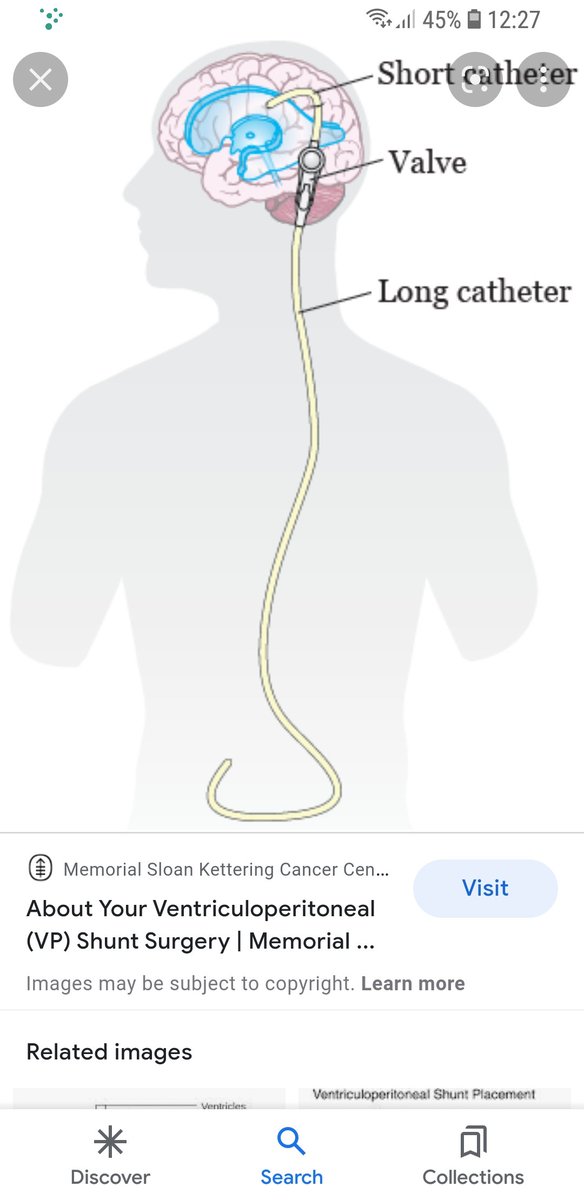 RayMairead's tweet photo. Head ones ready today, I'll do my peritoneal cavity (tummy) in a few days, feeling much better, thank you so much for all the kind words and concern x
#BrainTumour
#BrainSurgery
#NHS
#QEB https://t.co/aNAuMETaNE