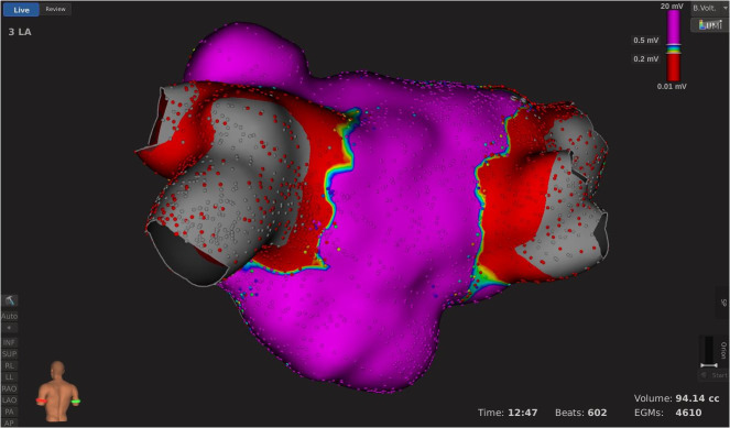 BSC_EU_Heart's tweet photo. #LocalImpedance drop may predict optimal lesion creation. Read from Dr. Szegedi et al. how the combination of local impedance and force in #STABLEPOINT ablation catheter helps #PV ablation: https://t.co/YuFnNJcLCf
#BSCEMEA Epeeps https://t.co/noH02Yavqs