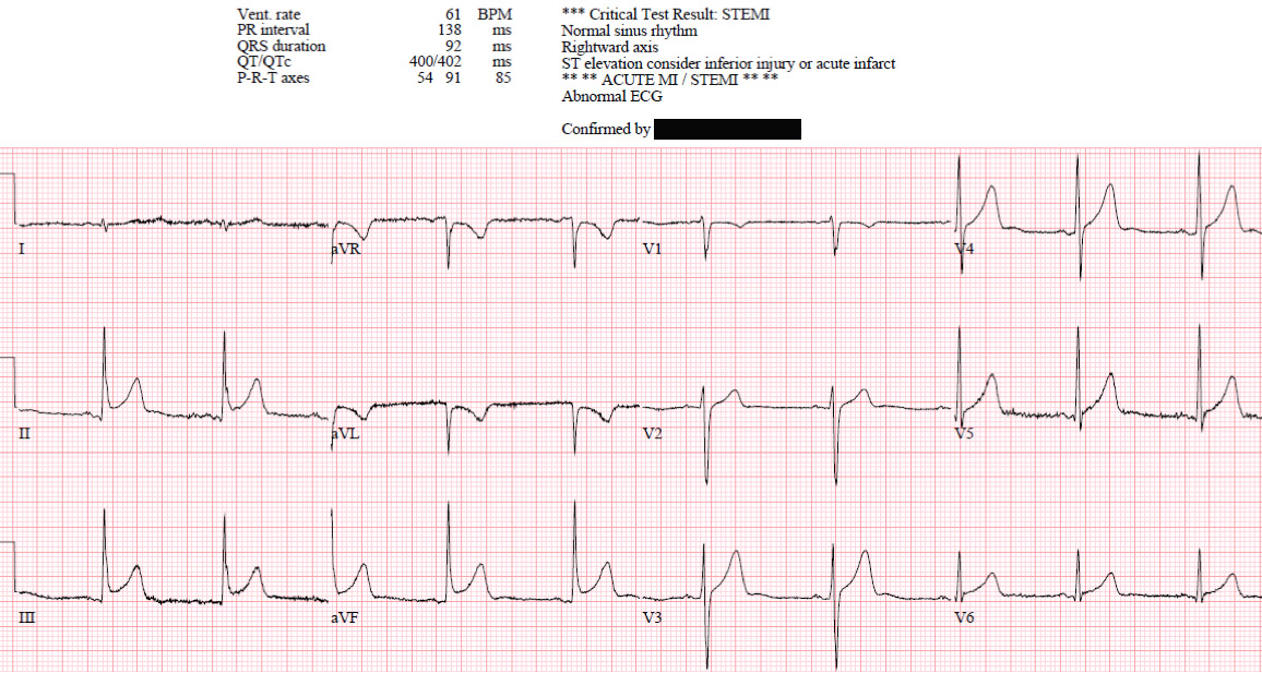Stephen W. Smith (@smithecgblog) on Twitter photo Inferior ST elevation with reciprocal change: which of these 4 patients has Occlusion MI? (1 of them is shown here) <a href="/ECGcases/">Jesse McLaren</a>
hqmeded-ecg.blogspot.com/2022/05/inferi… Inferior ST elevation with reciprocal change: which of these 4 patients has Occlusion MI? (1 of them is shown here) <a href="/ECGcases/">Jesse McLaren</a>
hqmeded-ecg.blogspot.com/2022/05/inferi…