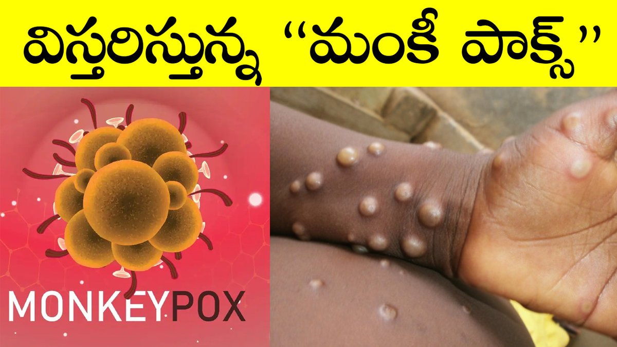 Monkeypox virus in India | monkey pox virus |Telangana99 youtu.be/5NXAkewsM6g via <a href="/YouTube/">YouTube</a> #monkeypox #MonkeypoxVirus #Telugu #TeluguNews #Telangana