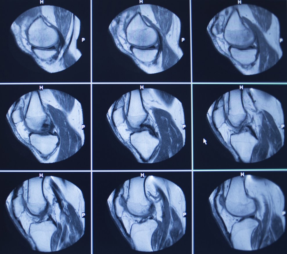 thekneedoc's tweet photo. Meniscal #trephination can be performed at the same time as other surgeries. It involves taking a small needle and puncturing into the joint lining &amp; into the substance of the #meniscus to try to stimulate a healing response at that location. More details: https://t.co/77ZzMaSzKN https://t.co/28m44JLBG6