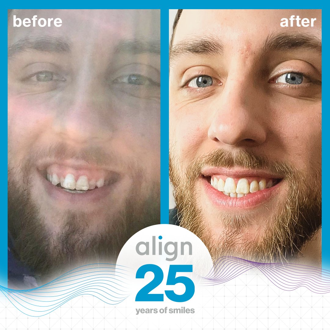 Transformation Tuesdays are all about looking forward - and after 25 years of transforming smiles around the world, we're excited to make it another 25 with folks like 📸joshuabasher. 😊 #invisalign #invisalignsmile #transformationtuesday