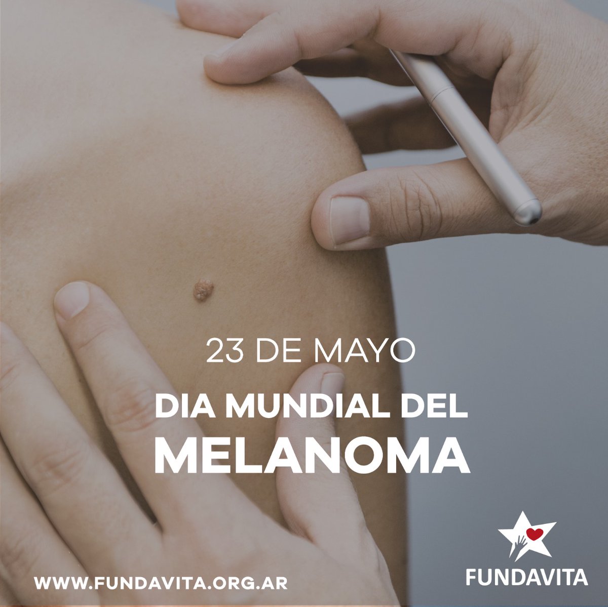 🗓23 de Mayo: 𝗗𝗶𝗮 𝗺𝘂𝗻𝗱𝗶𝗮𝗹 𝗱𝗲𝗹 𝗠𝗲𝗹𝗮𝗻𝗼𝗺𝗮 🔍

El melanoma es un tipo de cáncer de piel que se origina cuando los melanocitos comienzan a crecer sin control.

#prevención #concientizacion #melanoma #cancerdepiel