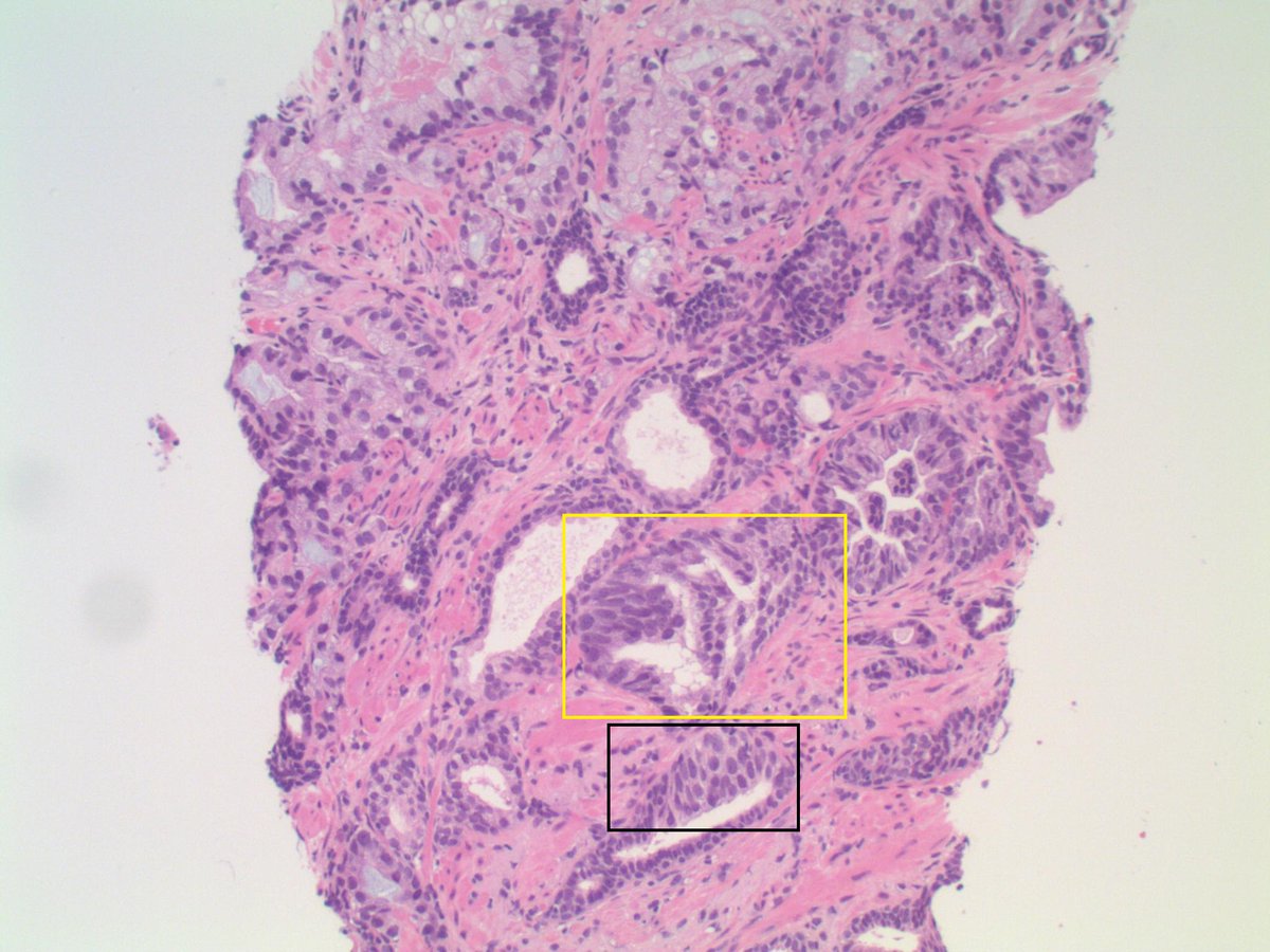 slusagar's tweet photo. #GUpath #grayzonepath prostate bx:
3+4 (better 4 elsewhere) but in these level sections shown, IDC elements or just "colonization" of adjacent glands? https://t.co/bI2HNcYN60