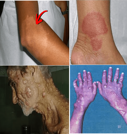 Hi @TravisSearles69 @OMS @09Esther Those are not bug bites. I had predicted, from what I had seen, and had posted it on Twitter that the next wave will come with skin lesions. No matter name already used to identify this disease, monkey pox, it's leprosy. it's just the beginning