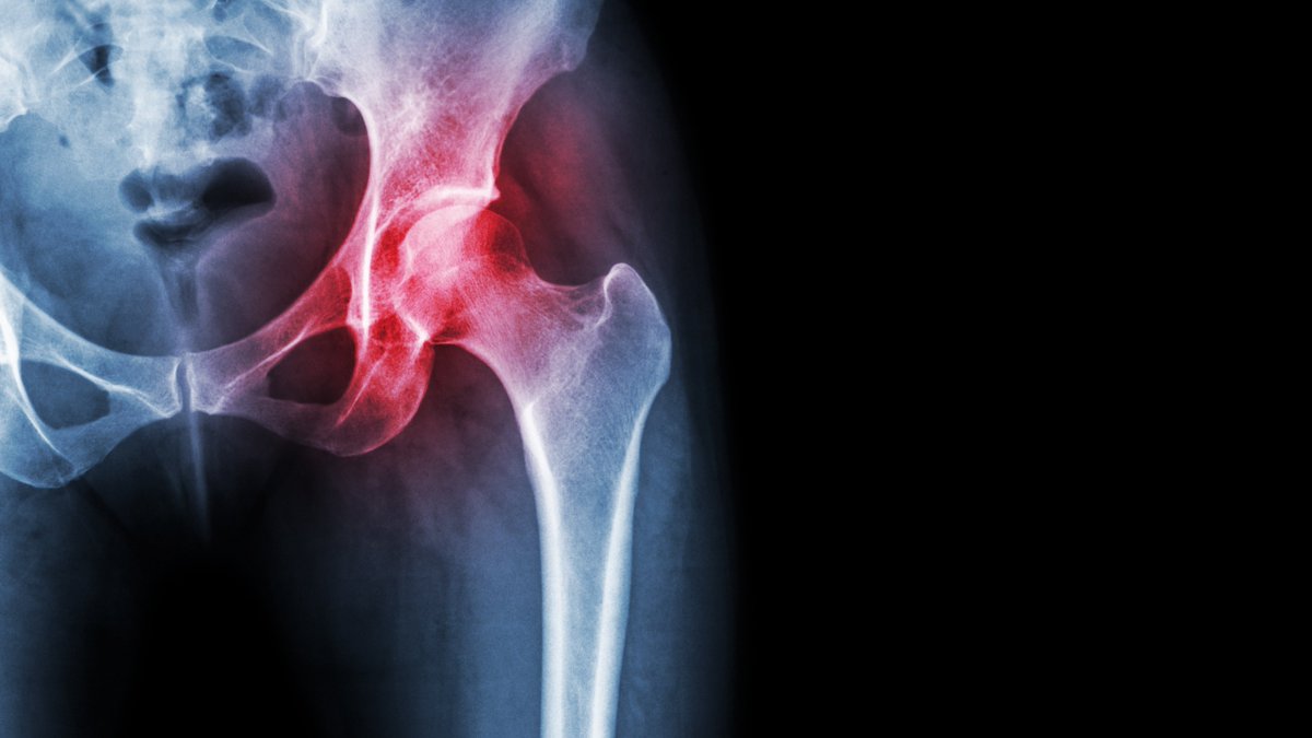 #Scottish hip replacement case may have wider implications for #consumer protection #law - Fiona McEwan writes in today's @TheScotsman blmlaw.com/news/hip-repla…