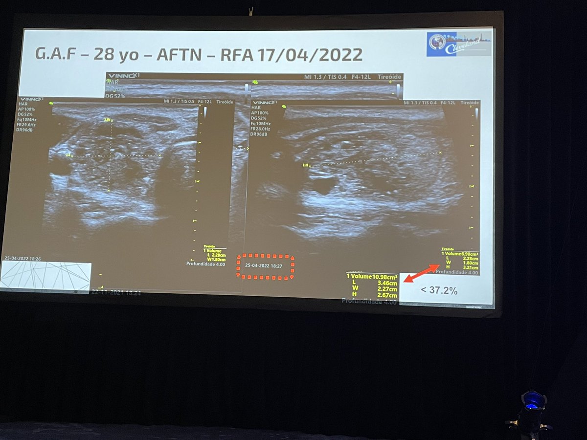 Dr. <a href="/Eriveltovolpi/">Erivelto Volpi MD, PhD</a> showing the dramatic reduction in volume of a hot thyroid nodule  after RFA in the Presidential session on emerging technologies in Endocrine surgery #AAES2022