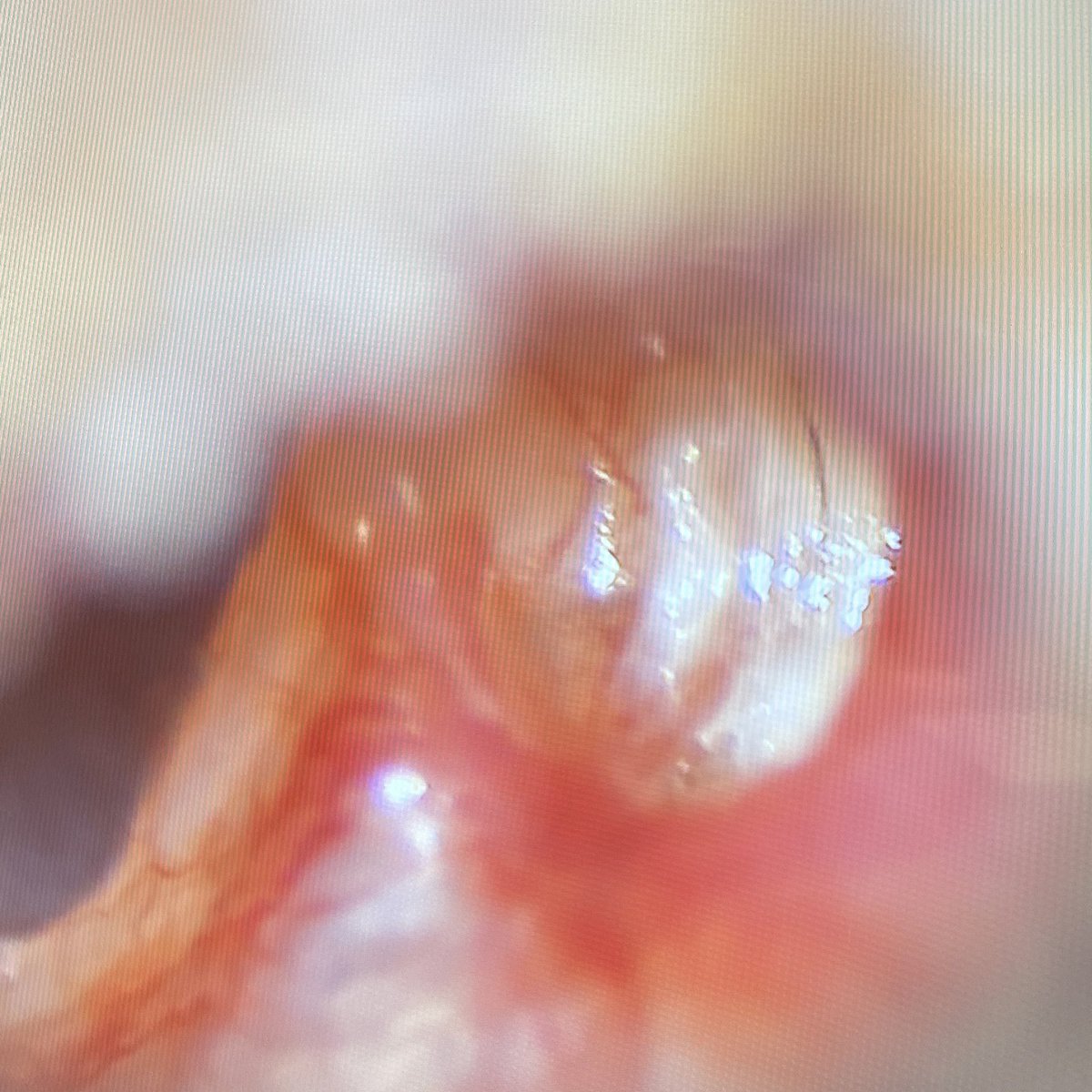 WilliamRBlythe's tweet photo. Left epitympanic retraction pocket and cholesteatoma.
#ENTwitter #GeneralENT https://t.co/G3jD4FERMw