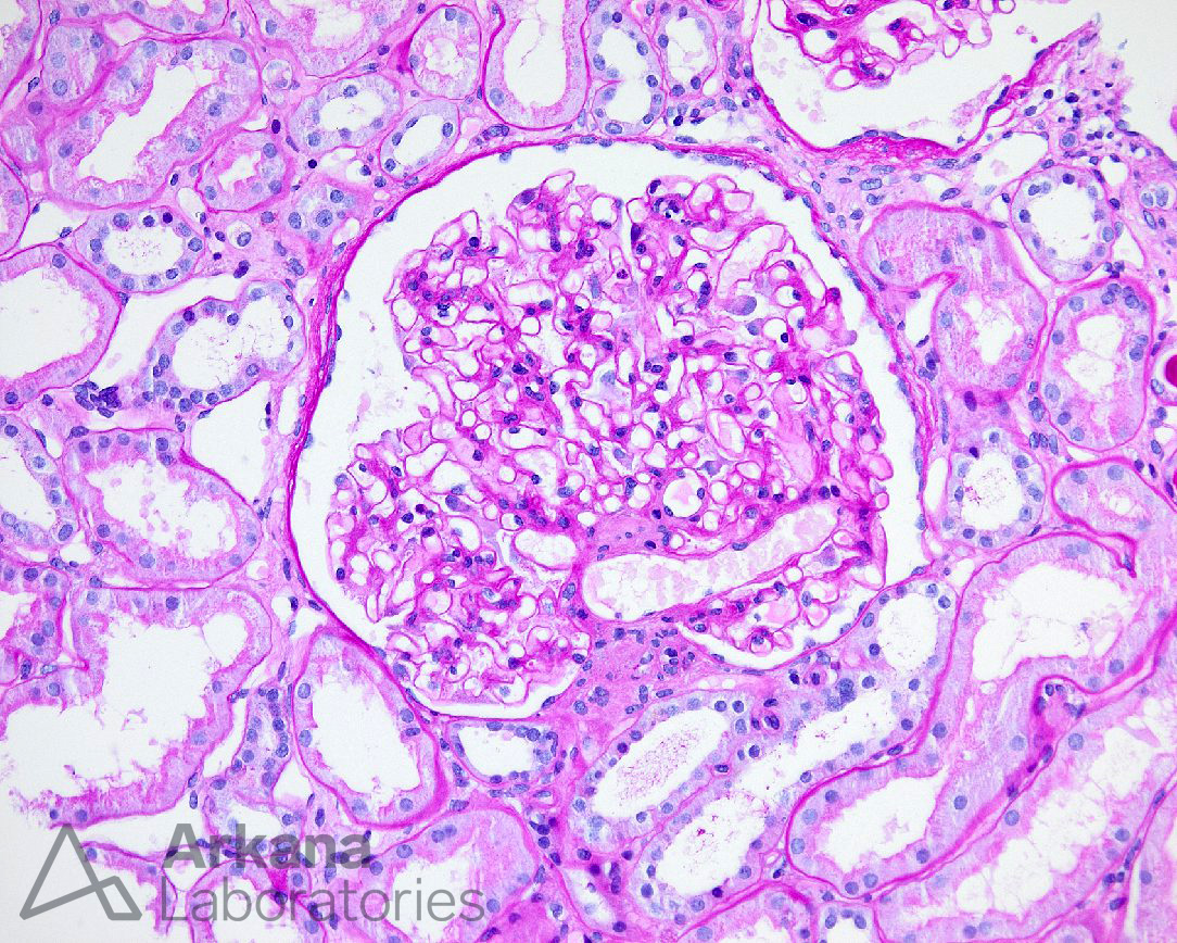 arkanalabs's tweet photo. What conditions would be in your differential diagnosis for this finding? #kidneypath

(Hint: large glomerulus) https://t.co/MGTmmoJ8gk