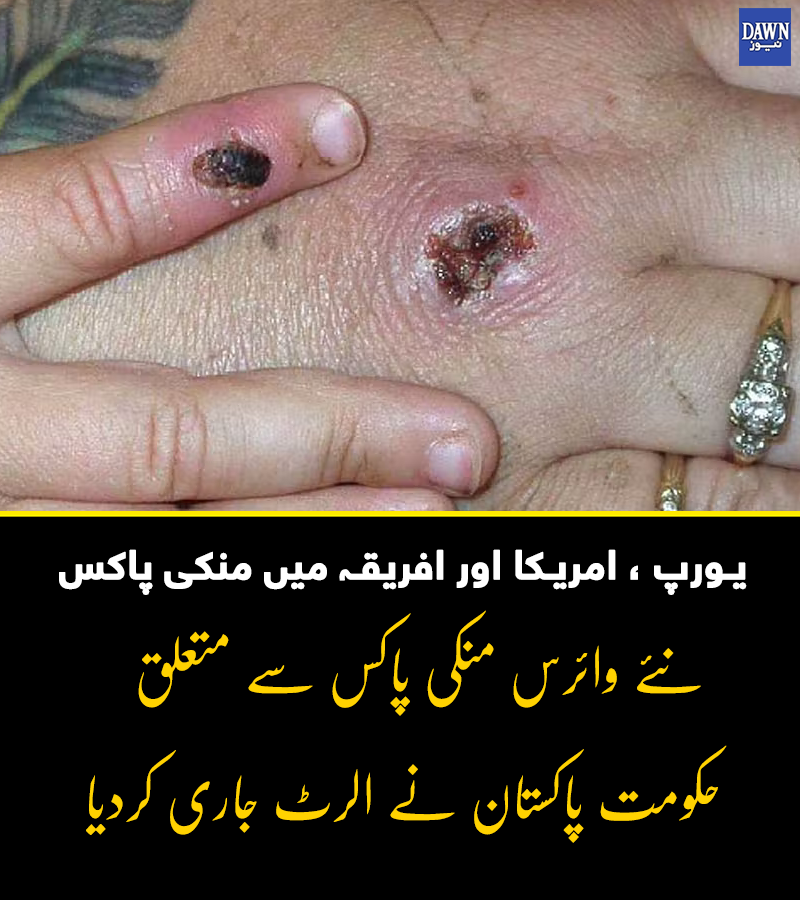 Dawn_News's tweet photo. جاری الرٹ میں کہا گیا ہے کہ یہ بیماری، وائرس سے متاثرہ جانوروں، انسانوں یا وائرس سے آلودہ چیز کو چھونے کے ذریعے لگ سکتی ہے، مزید یہ وائرس کھلی ہوئی جلد، سانس کی نالی، آنکھوں، ناک یا منہ کے ذریعے جسم میں داخل ہوتا ہے۔

https://t.co/naUdPokdoK https://t.co/iwfNI4fwLH