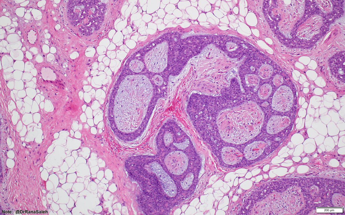 What to call this post auricular tumor? 3.0 cm encapsulated, Middle aged female #ENTpath <a href="/BinXu16/">Bin Xu</a> <a href="/HeadandNeckPath/">Lester Thompson</a>