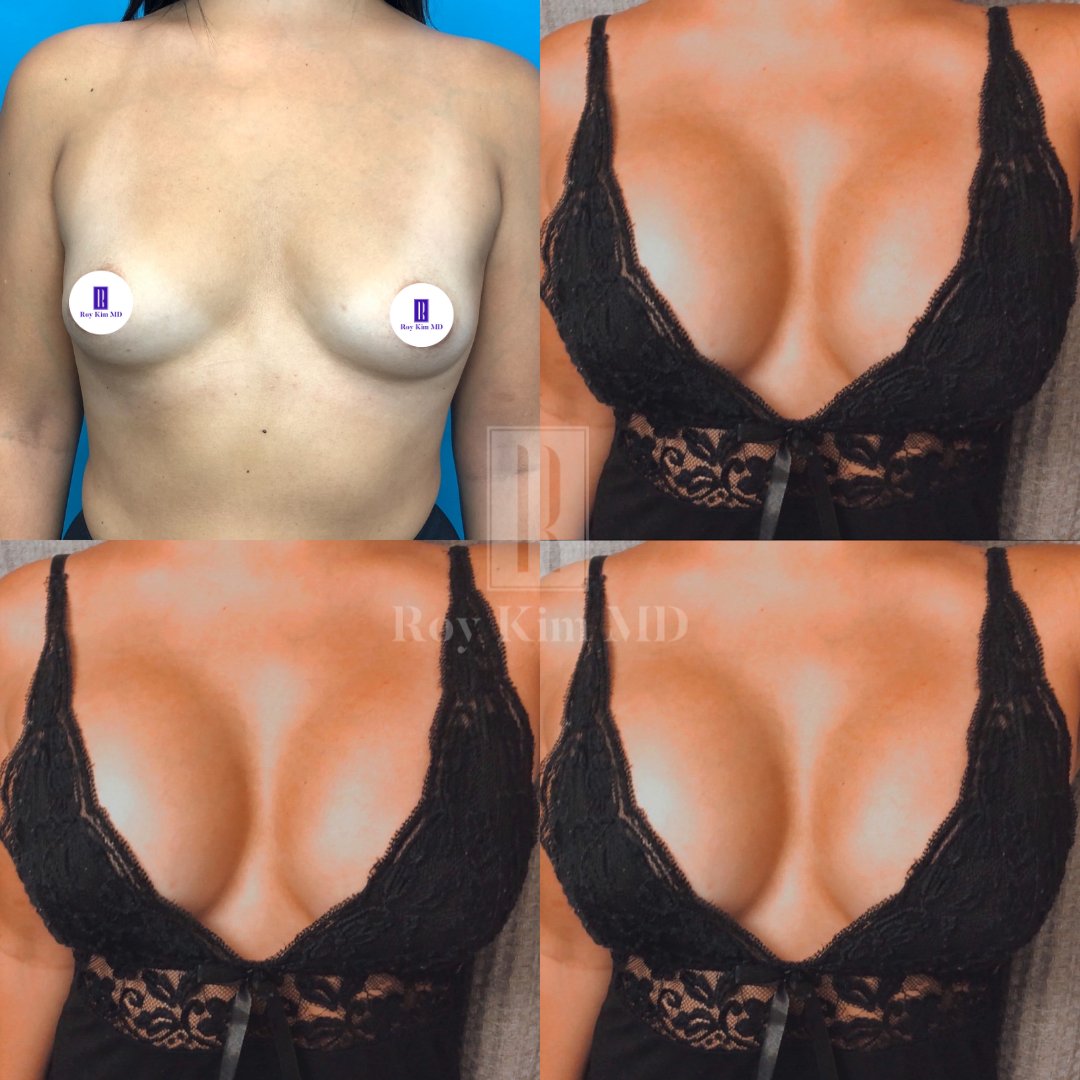 Roy Kim 🇺🇸 on X: 1 month cleavage update from my beautiful patient! 🤩🔥  ⠀ She had minimal breast tissue and ended up choosing 500cc moderate plus  implants to give her the