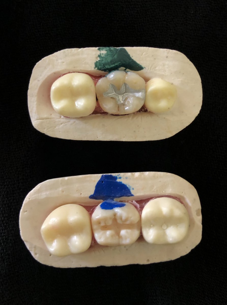 Operative exam done✅
class II amalgam restoration for lower 6 
class II cavity preparation for lower 7