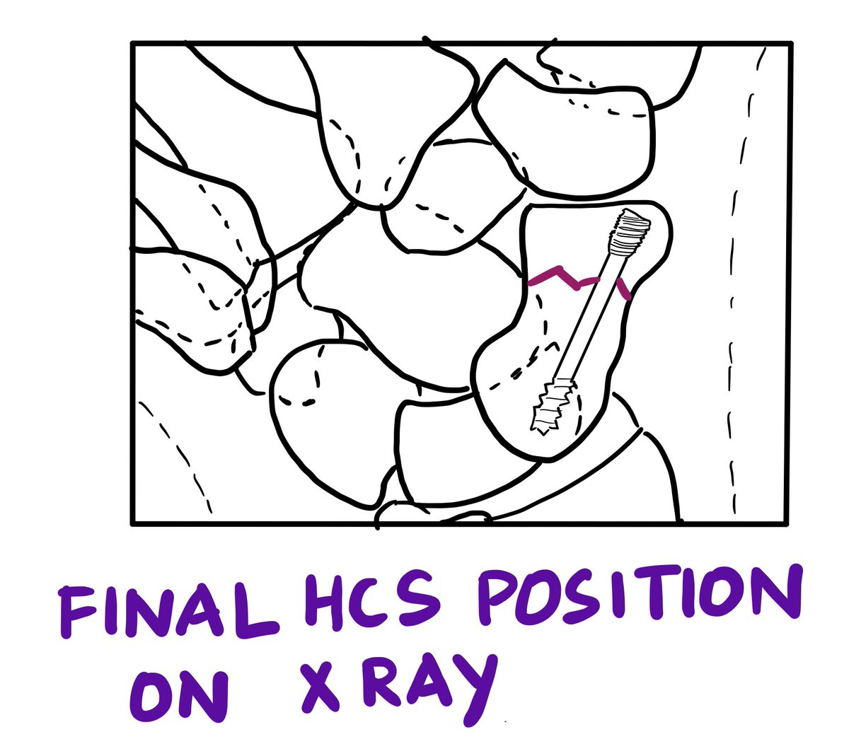 For fresh DISTAL pole and WAIST scaphoid fractures, 90 % of them can be FIXED by the volar approach....
